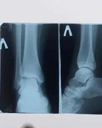 Two ankle X-rays on a lightbox